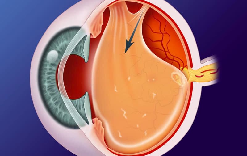 Décollement Du Vitré Et Maux De Tête Décollement postérieur du vitré | Ambulatorio oculistico Palomba